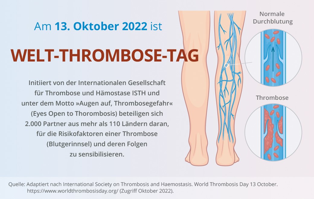 Infografik zum Welt-Thrombose-Tag 2022.